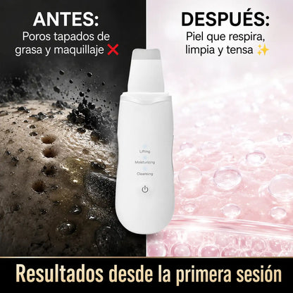 SonicPeel™ Pro - Espatula Facial Ultrasonica Exfoliante